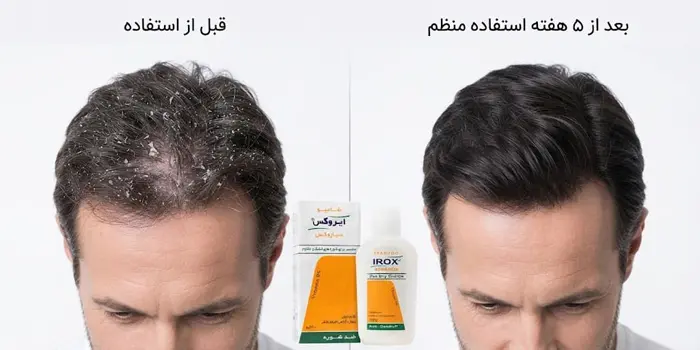 شامپو ضد شوره سباروکس ایروکس 42156341