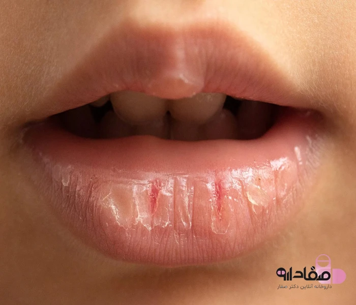 خشکی و ترک لب 6465412