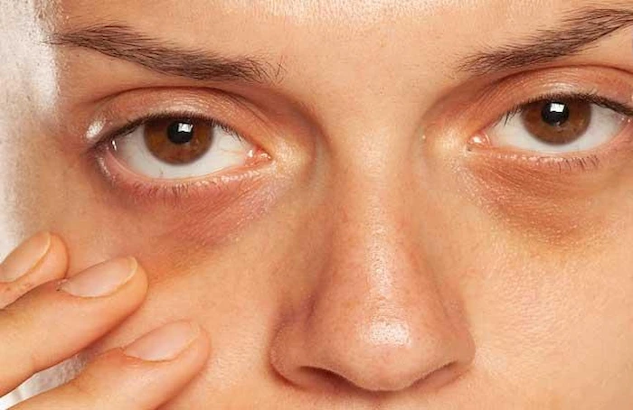 تیرگی زیر چشم در بانوان 645432