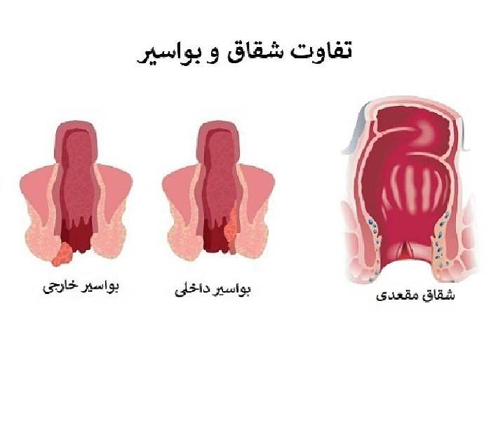 تفاوت شقاق و بواسیر 5465345312
