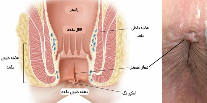 رشد بواسیر در مقعد 654653210
