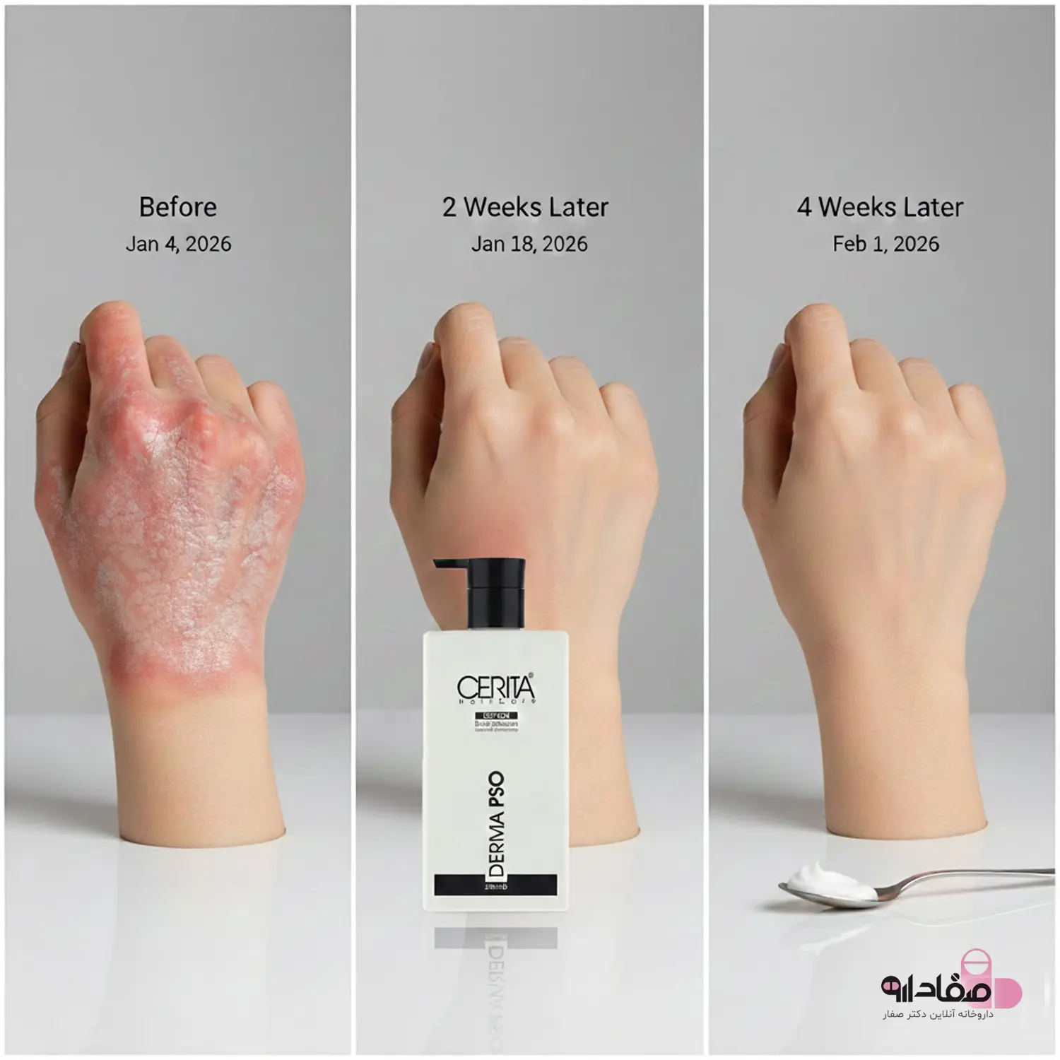 لوسیون بدن پسوریازیس سریتا مدل Derma PSO 64654