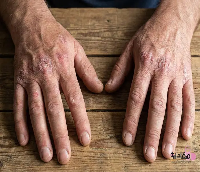 زخم های پوستی پسوریازیس 646543213