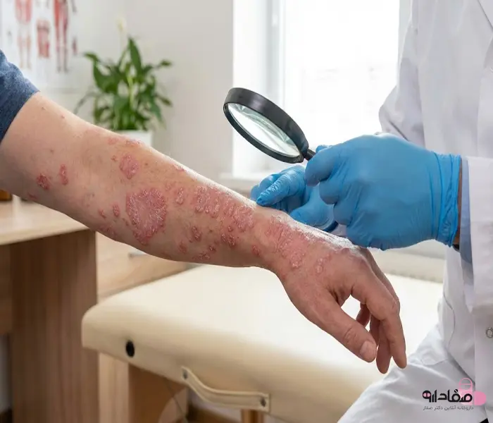 مشاهده بیماری پوستی پسوریازیس روی دست بیمار 56415312