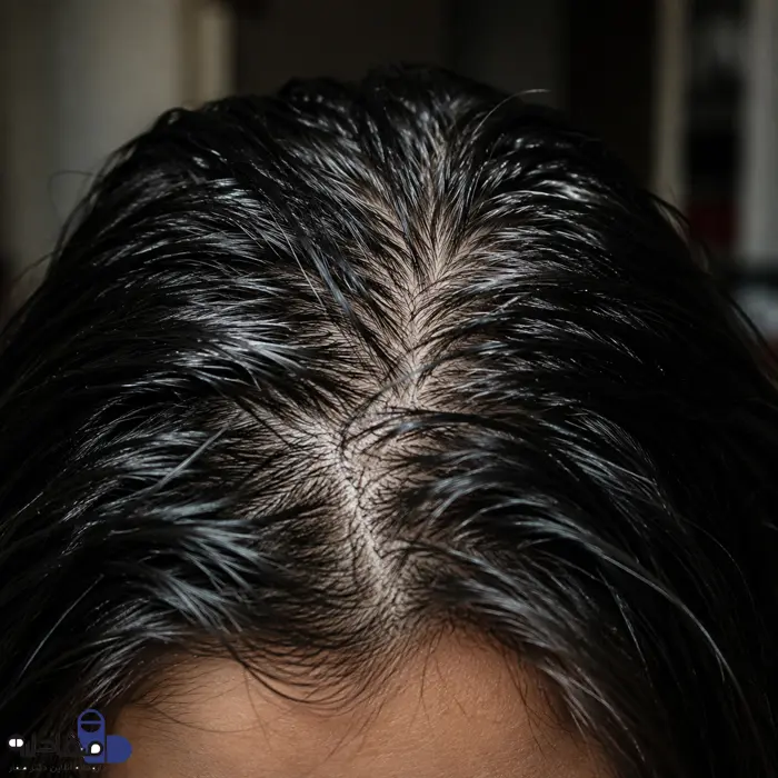 چربی بیش از اندازه کف سر 654654561